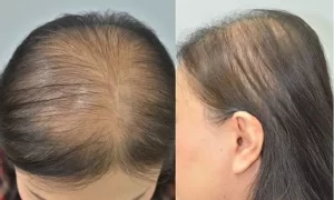 Alopecia-partial-absent-hair