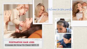 Postpartum-Hair-Loss-Causes-and-How-To-Deal-With-It