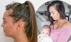 Postpartum-Hair-Loss-Causes-and-How-To-Deal-With-It