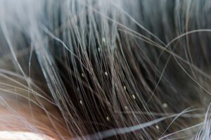 Itchy-Scalp-How-To-Prevent-And-Treatment