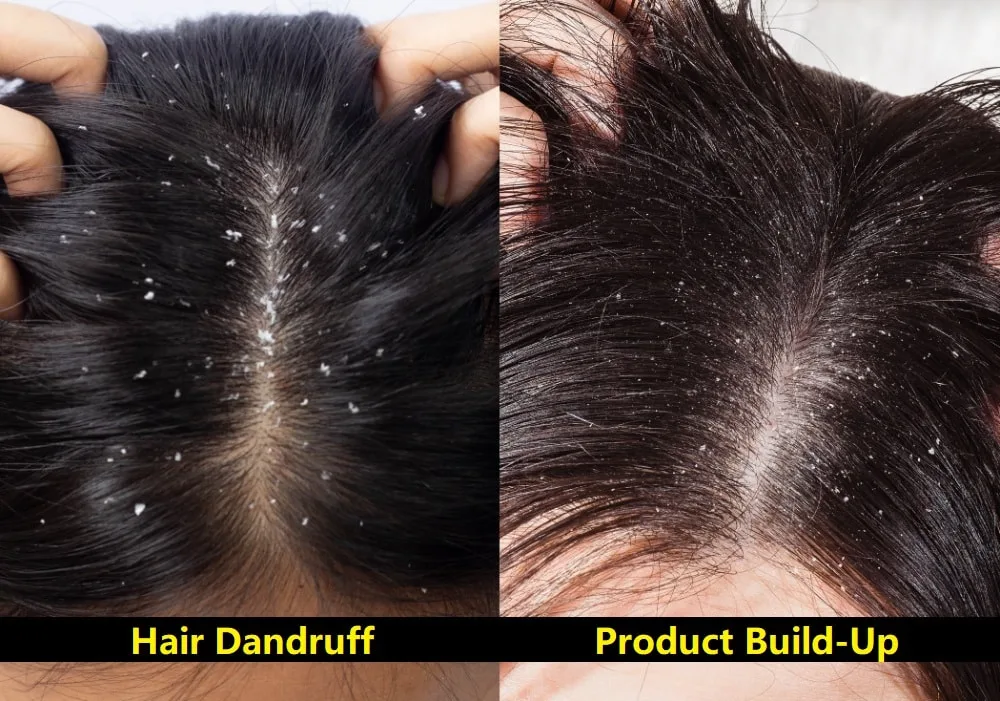 Dandruff with tape in hair extensions best sale