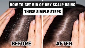 How-To-Get-Rid-of-Dry-Scalp-Using-These-Simple-Steps