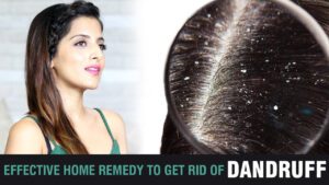 How-To-Get-Rid-of-Dandruff