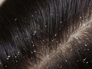 How-To-Get-Rid-of-Dandruff