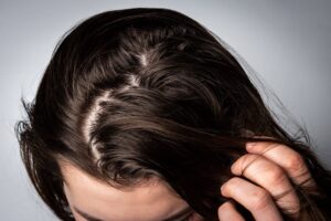 How-Does-Scalp-Condition-Affects-Your-Hair-Washing-Frequency