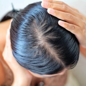 Effective-Tips-To-Get-Rid-of-Oily-Scalp-2024