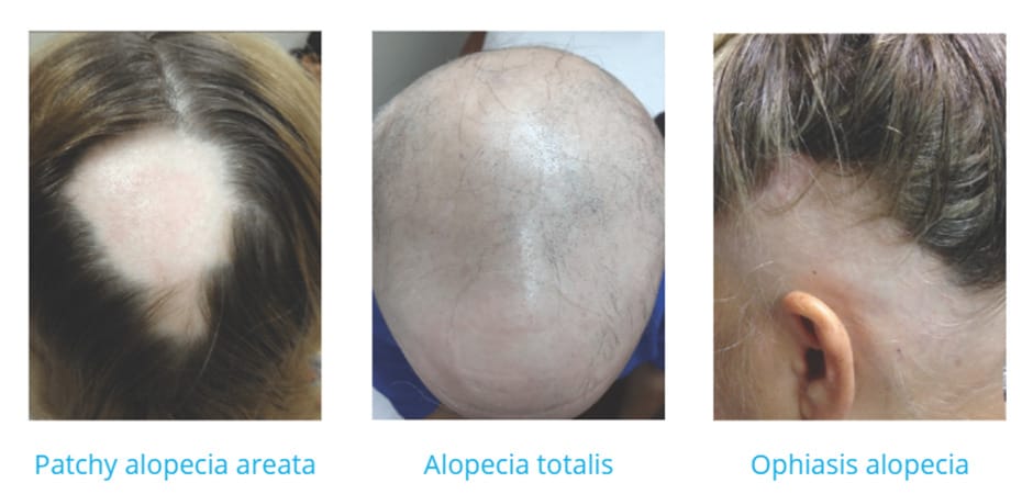 Best-Hair-Extensions-for-Alopecia-Updated-2024